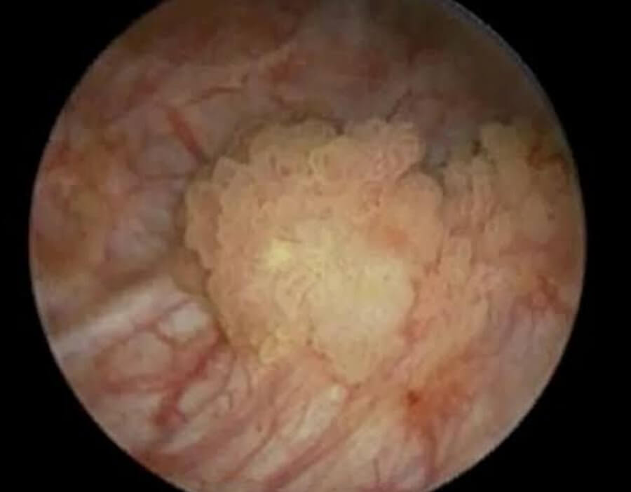 bladder cancer