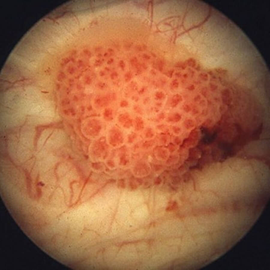 bladder cancer