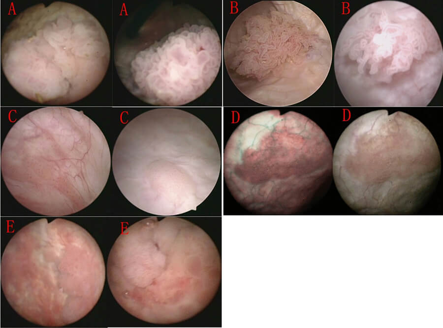 bladder cancer