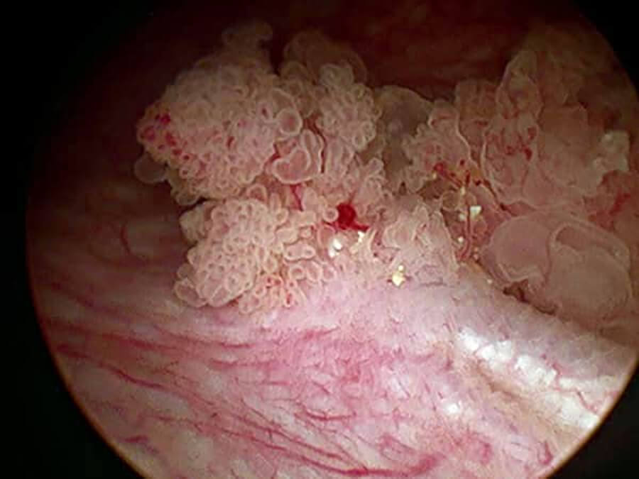 bladder cancer