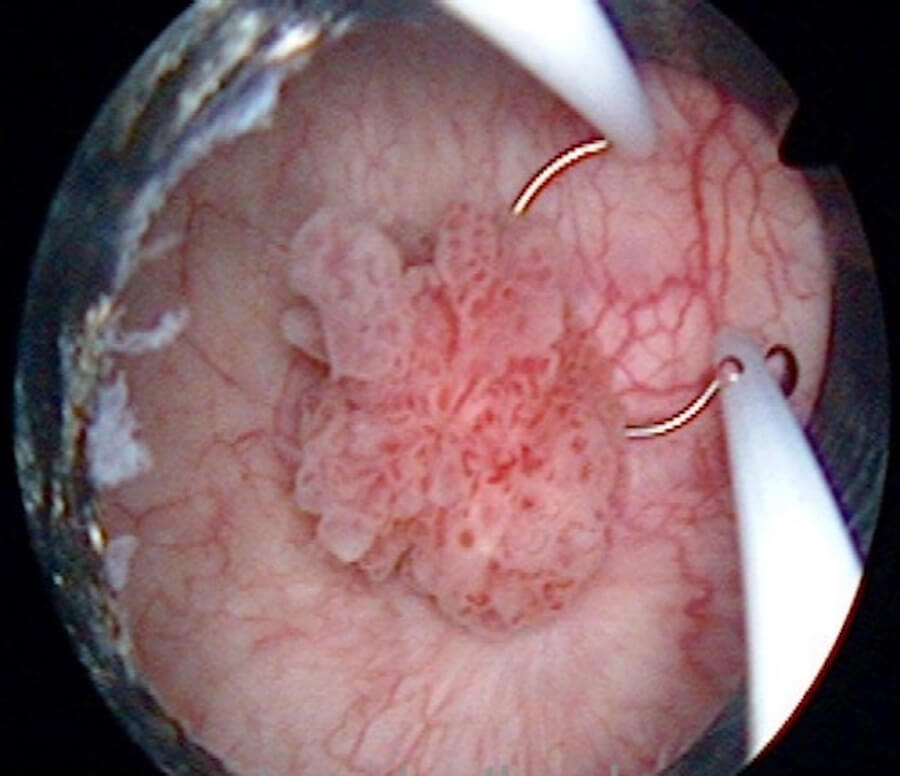 bladder cancer