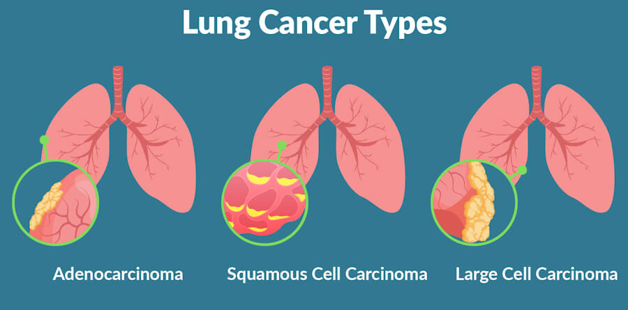 Lung Cancer