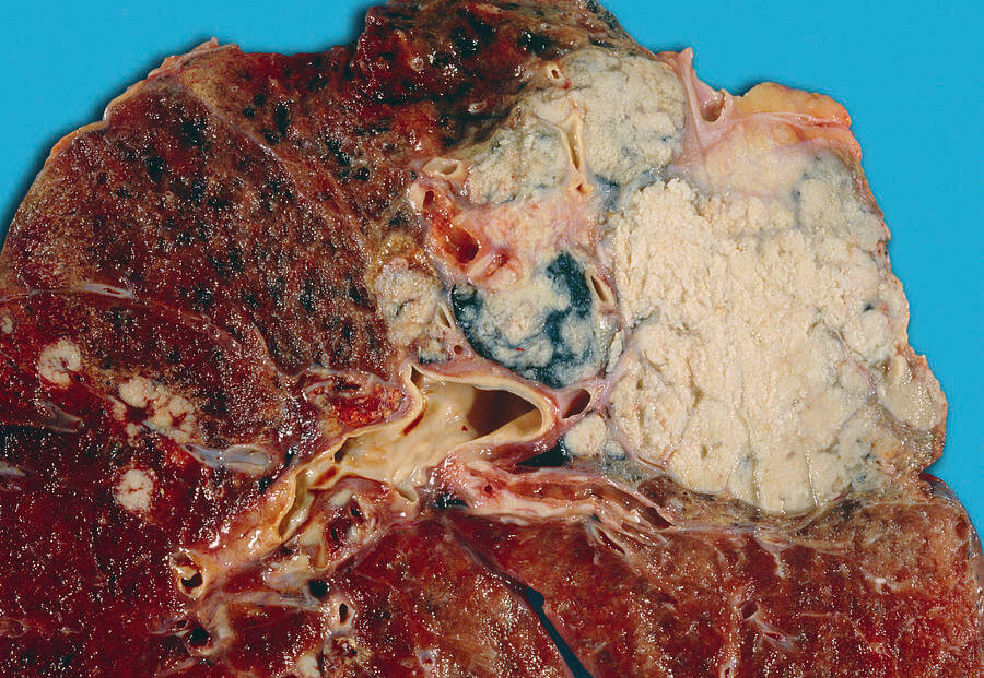 Lung Cancer