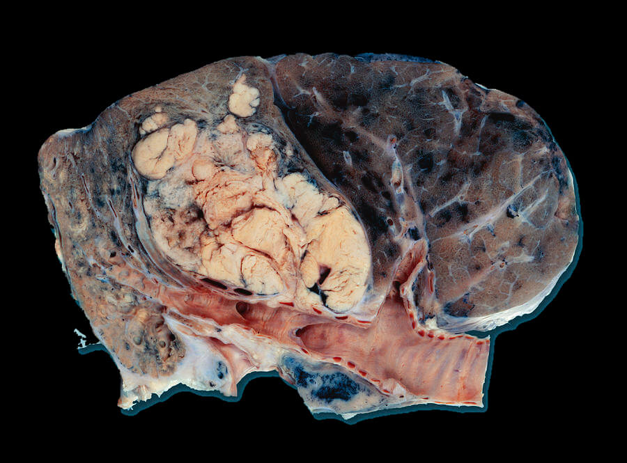 Lung Cancer