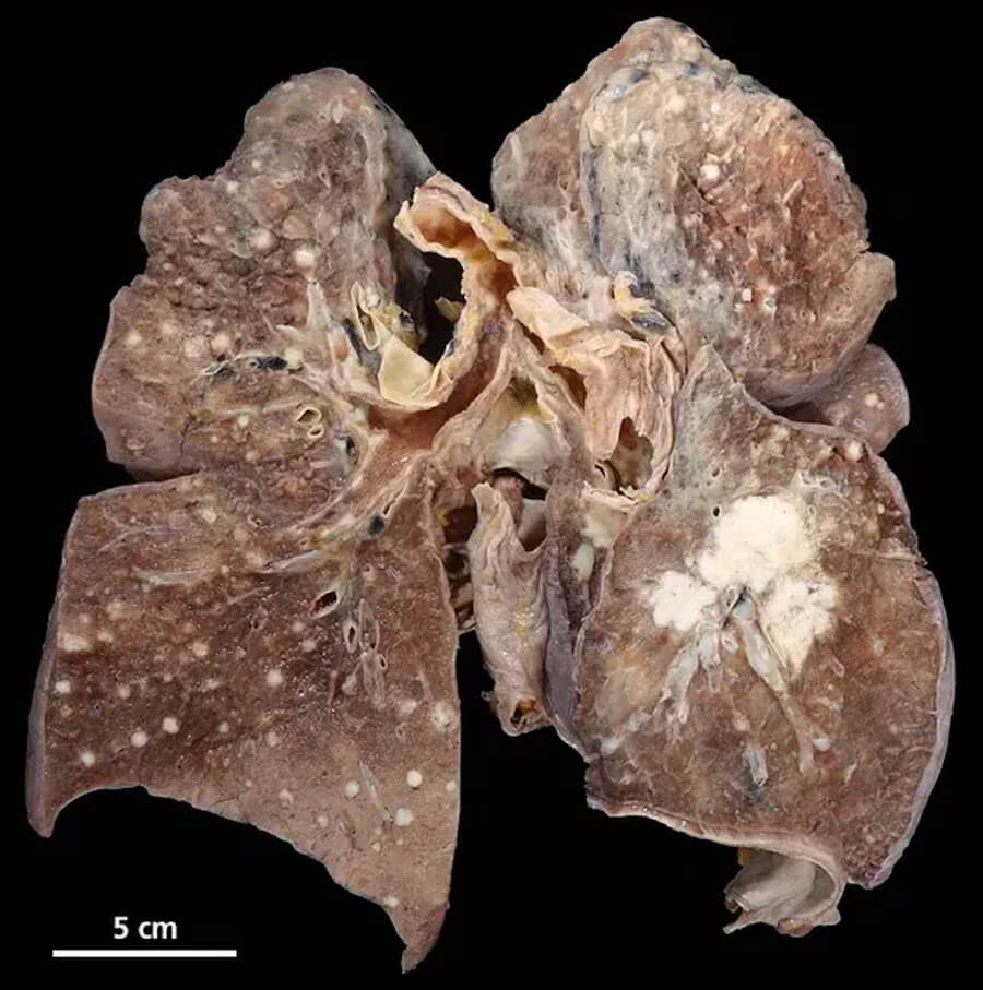 Lung Cancer