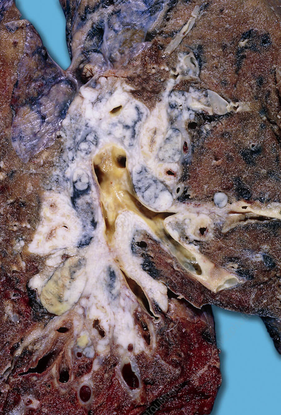 Lung Cancer