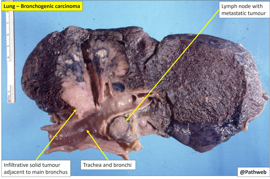 Lung Cancer