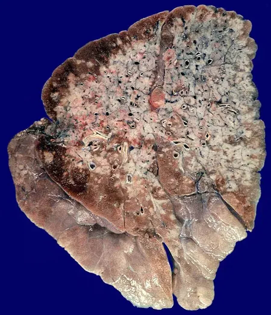 Lung Cancer