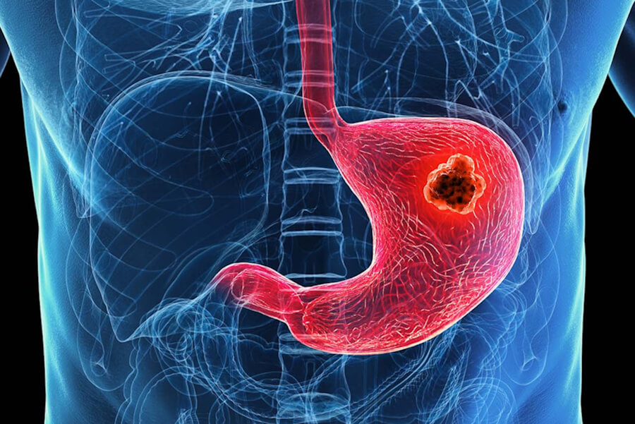 Stomach cancer
